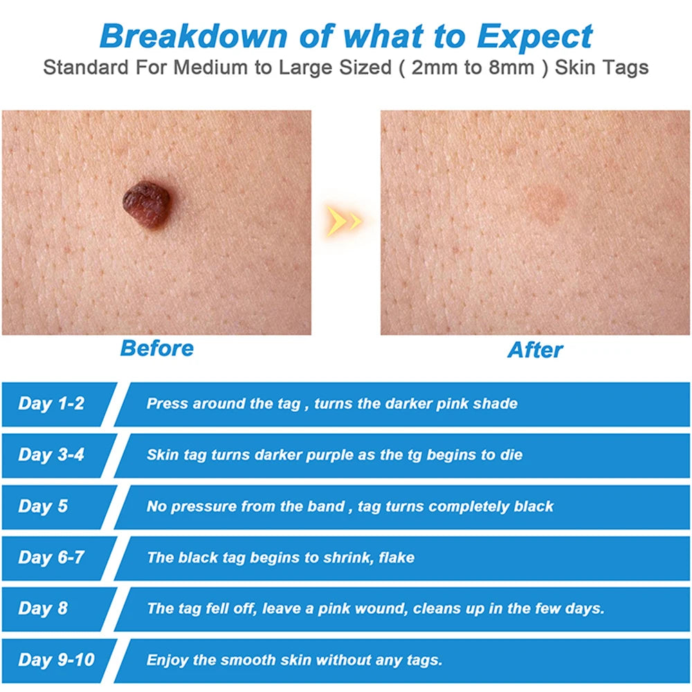 Skin: 2-in-1 Skin Tag Remover Kit, Achieve Flawless Skin!!